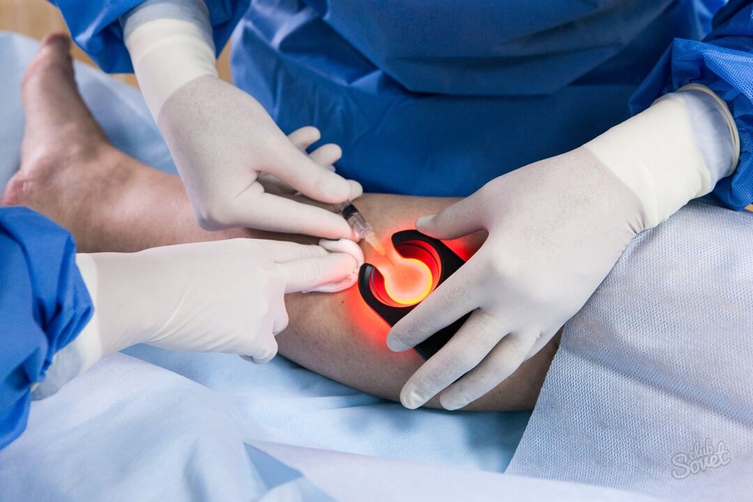Krampfadern in diagnostischen Beinen