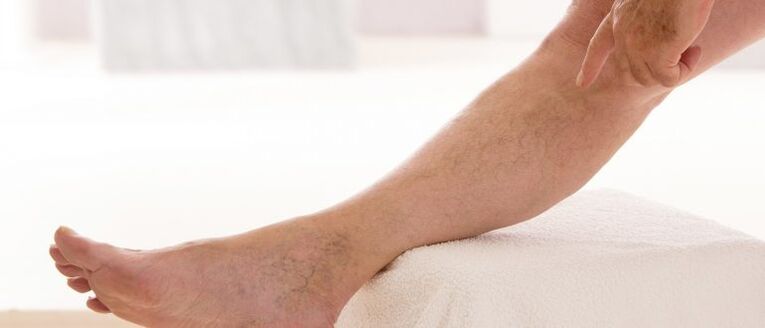 Krampfadern an den Beinen.